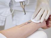 laser tattoo removal clinic