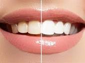teeth whitening brand france